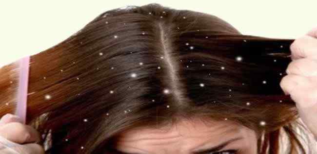 Cabelo-com-caspa.jpg