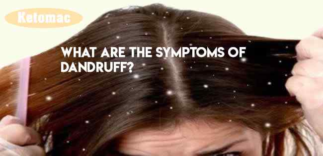 symptoms of dandruff