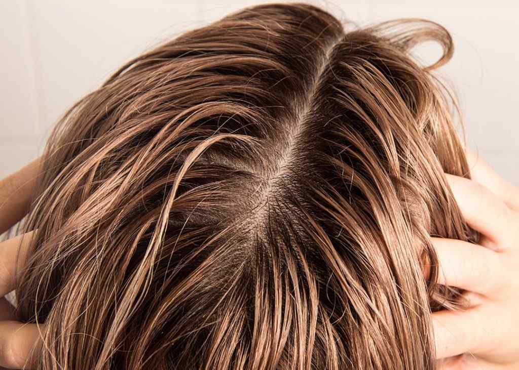 How to Get Rid of Dandruff